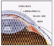 閉角型青光眼