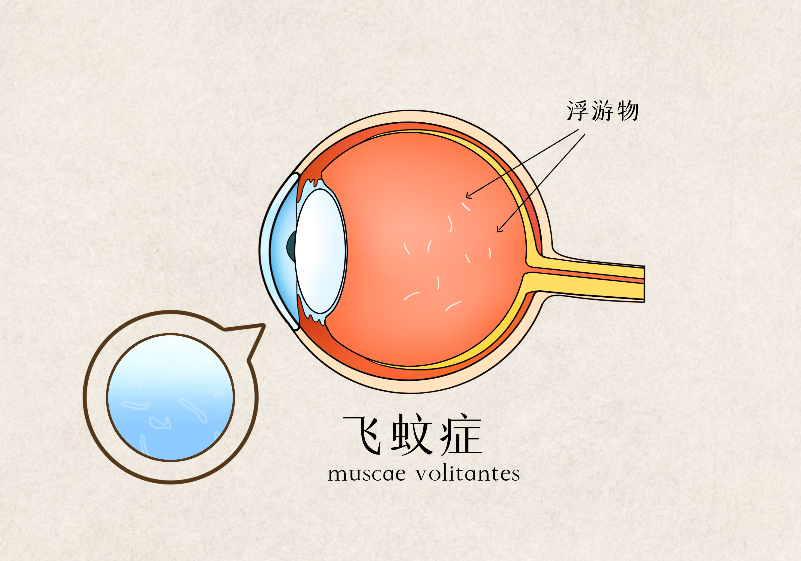 眼睛飛蚊癥