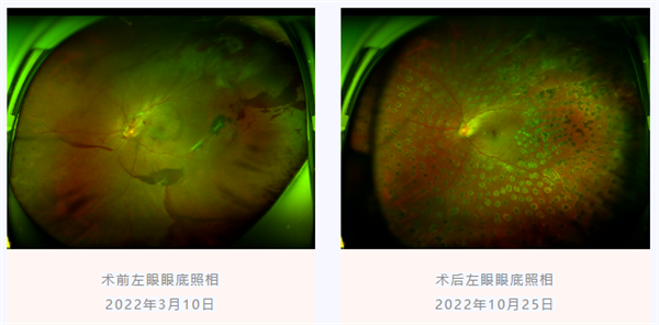 糖尿病視網膜病變