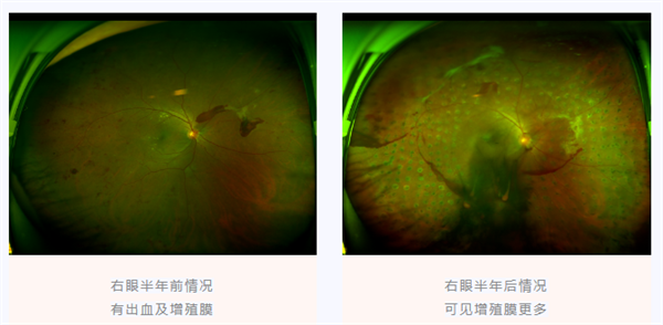 糖尿病視網膜病變